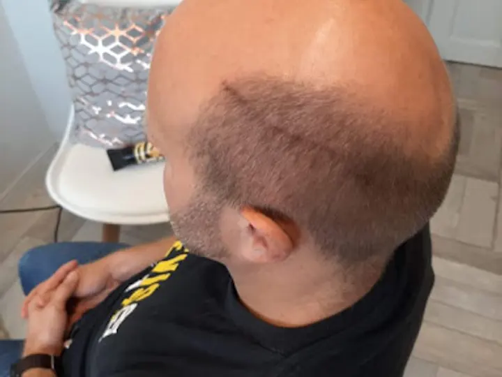 Men's Hair Systems Ni in Londonderry