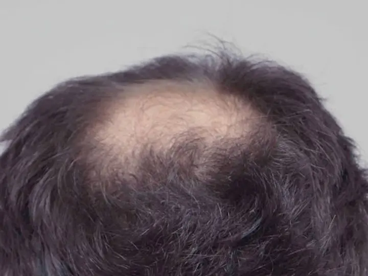 New Hair Clinic in Limerick